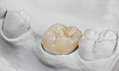 Prótesis dentaria